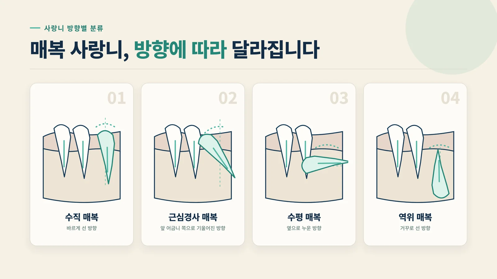 매복 사랑니 방향별 유형 다이어그램 — 수직·근심경사·수평·역위 매복